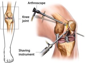 Arthroscopy surgery