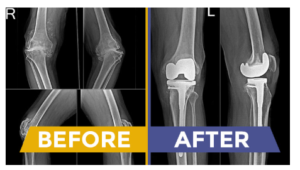 full knee replacement surgery