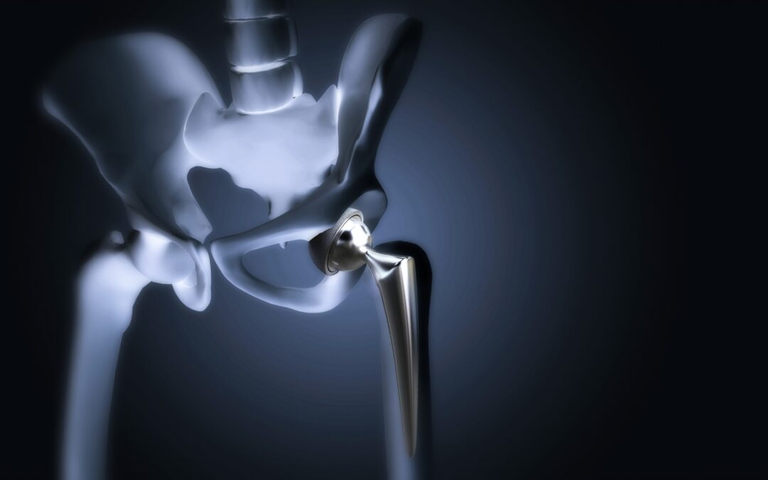 Everything You Need to Know About Hip Replacement Surgery