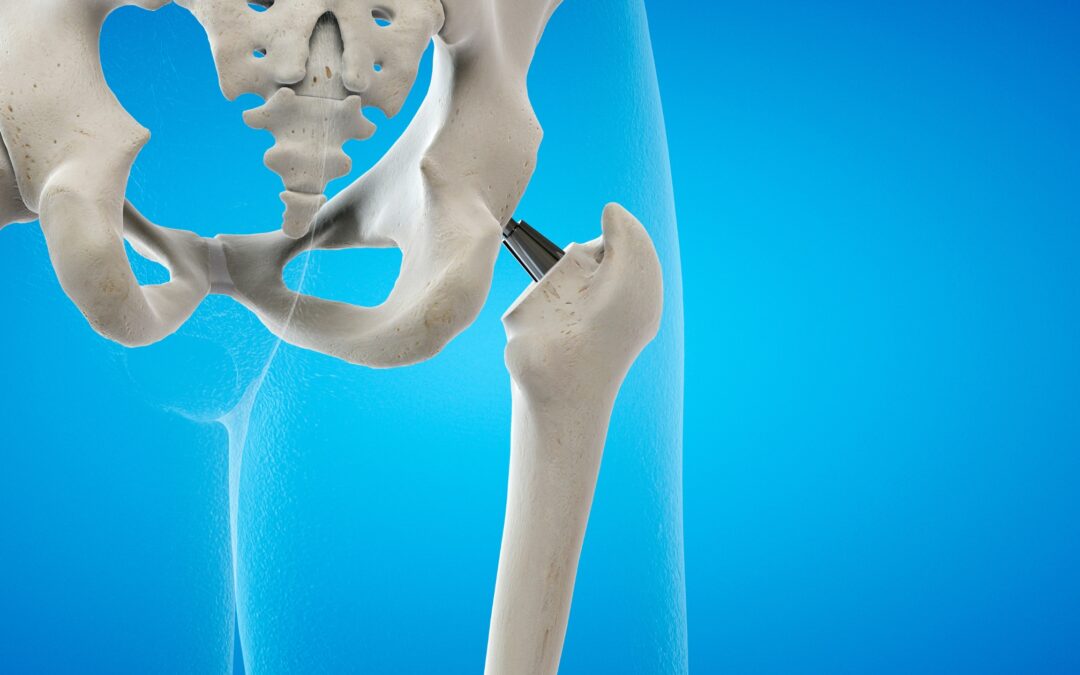 Hip Replacement Surgery at Vidyasagar Hospital – Restoring Mobility with Expertise