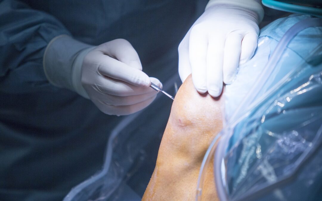 What to Expect During a Total Knee Replacement Surgery Procedure